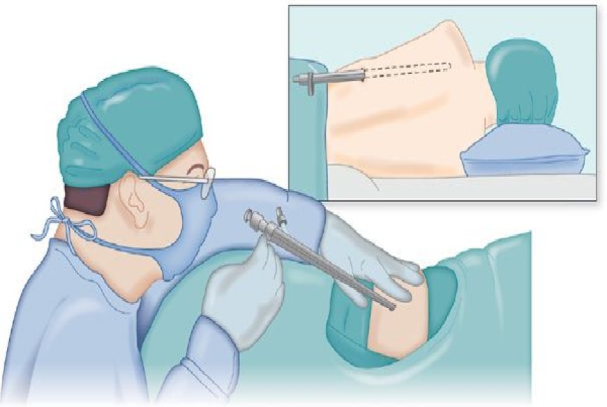 Thoracoscopy Procedure Proves Beneficial in Alleviating Pleural Effusion for Patients